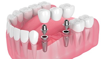 Illustration of an implant bridge