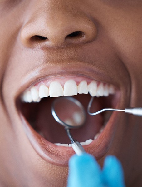 Closeup of a patient’s mouth being examined with dental instruments 