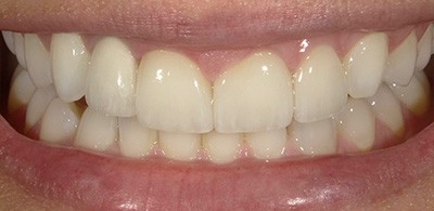 Smile Makeover - Case 2 - After image