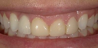 Smile Makeover - Case 2 - Before image