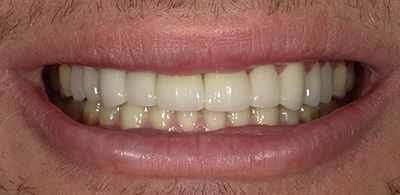 Smile Makeover - Case 3 - After image