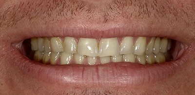 Smile Makeover - Case 3 - Before image
