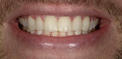 Smile Makeover - Case 4 - After image