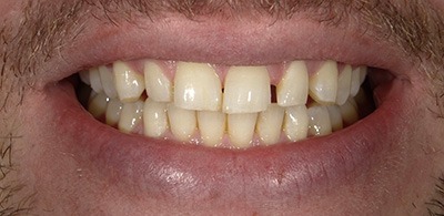 Smile Makeover - Case 4 - Before image