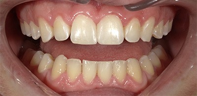Smile Makeover - Case 5 - After image