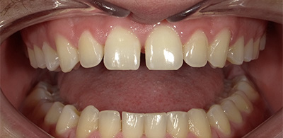 Smile Makeover - Case 5 - Before image