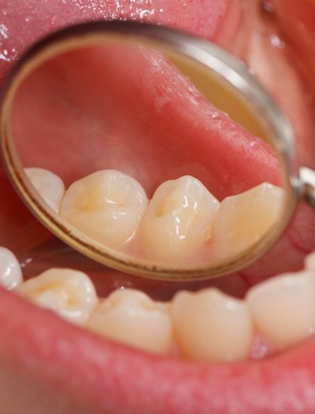 Closeup of smile after treatment with all ceramic dental restorations