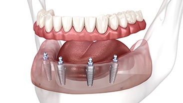 Rendering of implant dentures in a transparent jaw with a white background