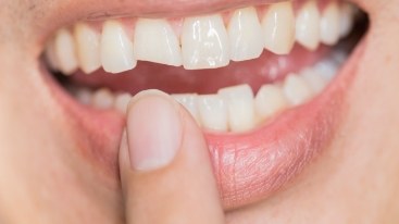 Closeup of smile with chipped tooth