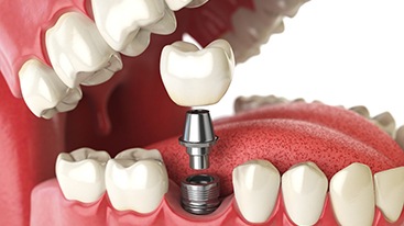 Graphic showing parts of a dental implant in mouth