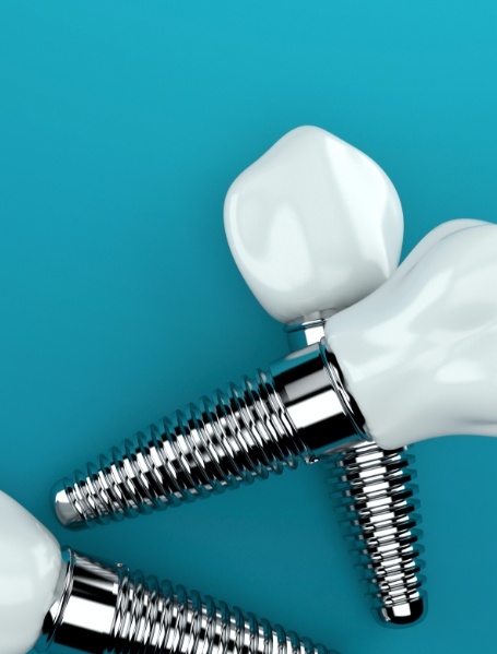Three animated dental implant supported dental crowns