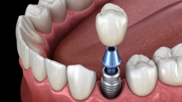 Animated dental implant supported dental crown placement