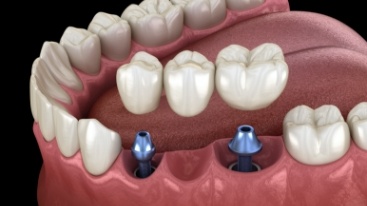 Animated dental implant supported fixed bridge placement