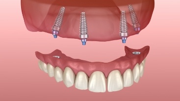 Animated dental implant supported denture placement