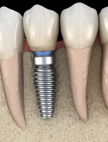 Animated smile with dental implant supported dental crown