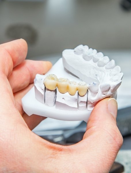 Model smile with dental bridge to replace missing teeth