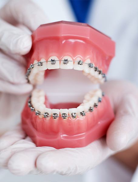 Model smile with traditional braces