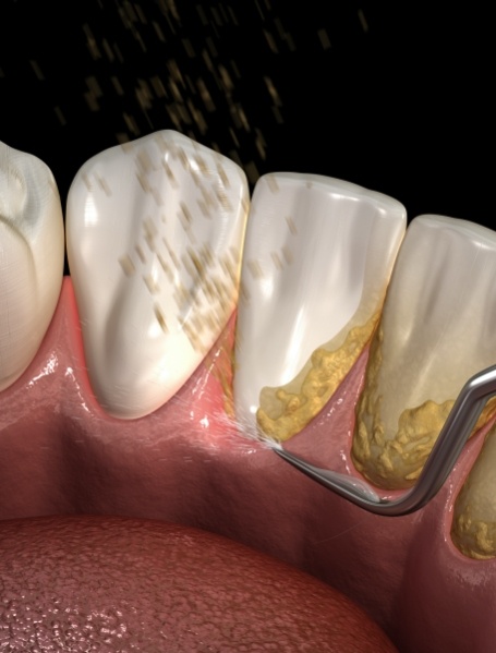 Animated smile during scaling and root planing periodontal therapy