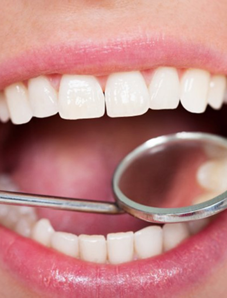 Dental mirror shows inconspicuous white filling