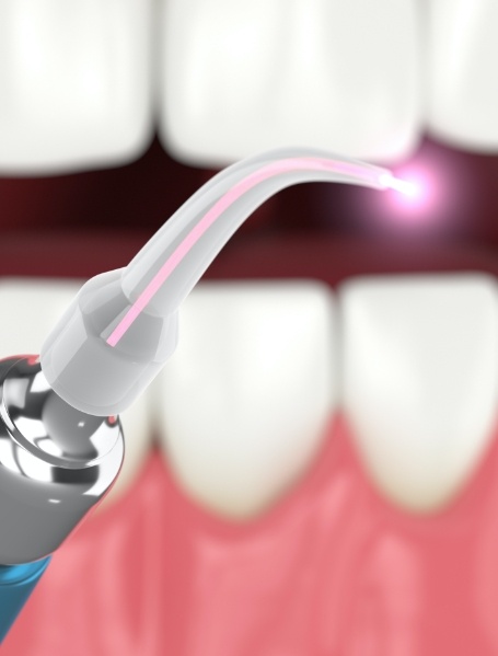 Soft tissue laser dentistry tool