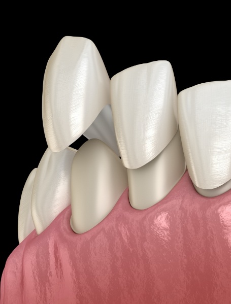 Animated smile during porcelain veneer placement