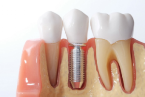 model of dental implant