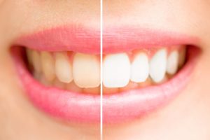 Discolored teeth vs. whitened teeth.