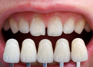 are-candidate-porcelain-veneers-in-hamden-learn