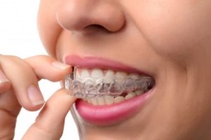 Woman placing a clear retainer onto her teeth