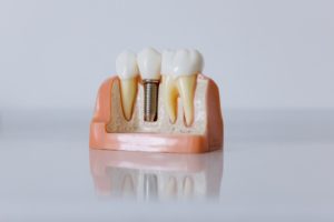 Model of single dental implant