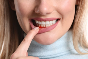 a closeup of a patient’s smile and gums