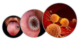 Model of oral cancer on a tongue